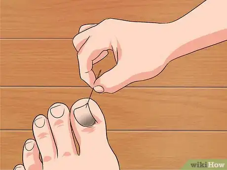 Image titled Remove a Dead Toenail Step 4