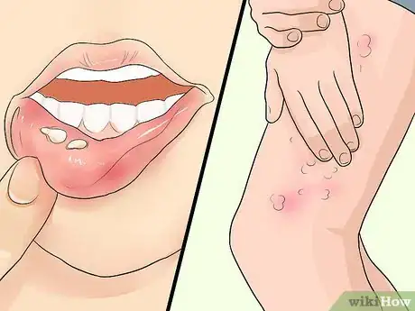 Image titled Recognize Herpes Step 5