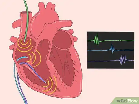 Image titled Identify Heart Blocks Step 8
