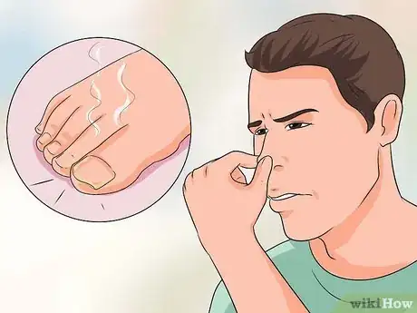 Image titled Cure Nail Fungus Step 2