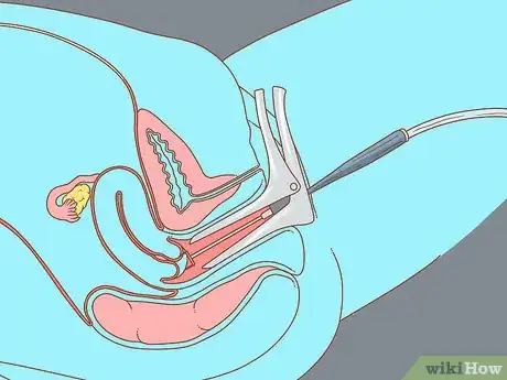 Image titled Test for HPV Step 14