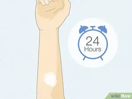 Image titled Patch Test Skin Step 12