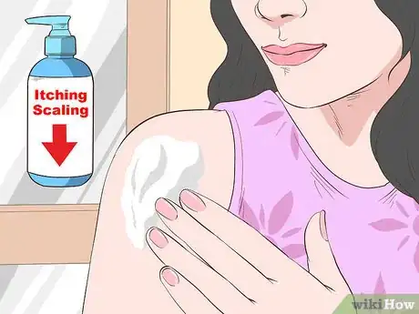 Image titled Care for Psoriasis Step 3