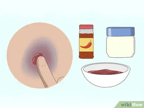 Image titled Make a Bruise Go Away Faster Step 13