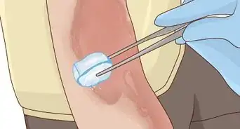 Use Honey as a Topical Antibiotic