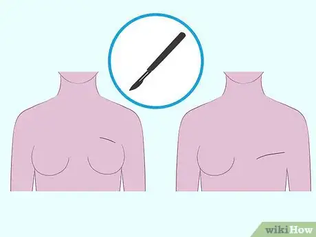 Image titled Diagnose Breast Cancer Step 12