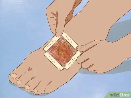 Image titled Apply Different Types of Bandages Step 8