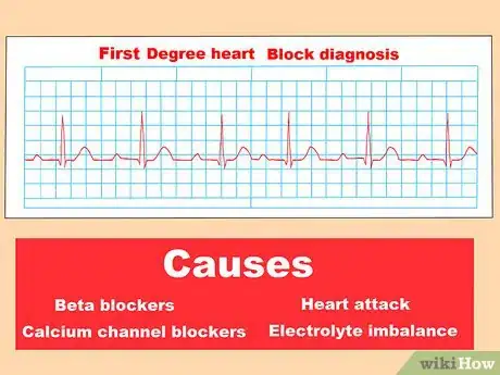 Image titled Identify Heart Blocks Step 9