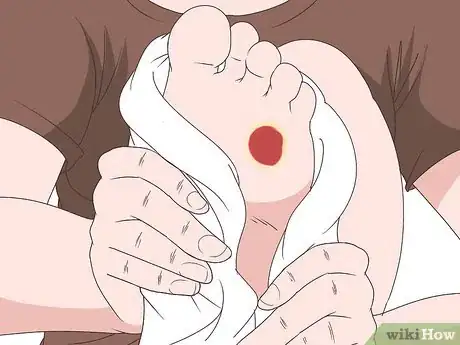 Image titled Heal Foot Ulcers Step 6