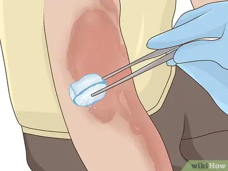 Image titled Use Honey as a Topical Antibiotic Step 14