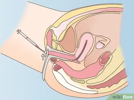 Image titled Get Fertility Treatments Step 14