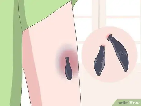 Image titled Make a Bruise Go Away Faster Step 21