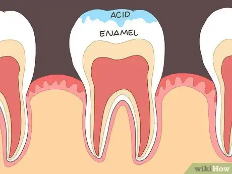 Image titled Prevent Tooth Enamel Erosion Step 1