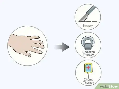 Image titled Identify Lymphedema Step 5