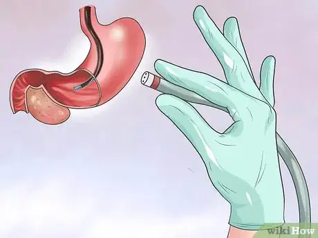 Image titled Screen for Pancreatic Cancer Step 3