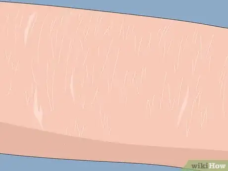 Image titled Treat Ichthyosis Step 1