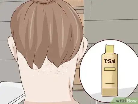 Image titled Get Rid of Dandruff at Home Step 4