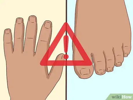 Image titled Treat Both Psoriatic Arthritis and Psoriasis Step 14