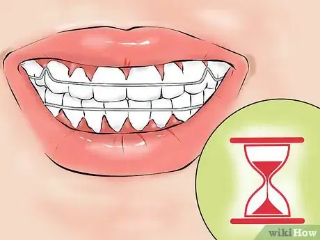 Image titled Deal With Dental Devices Step 6