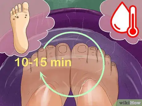 Image titled Pumice a Wart Step 1