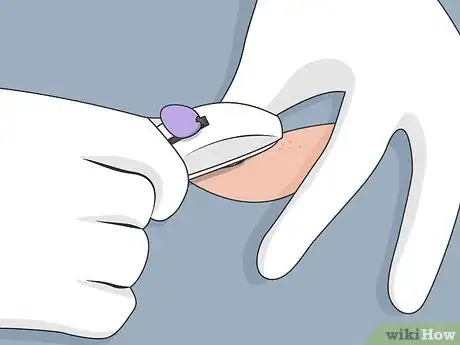 Image titled Remove Nexplanon Step 8