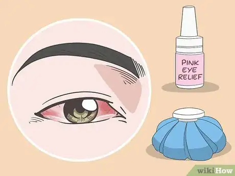 Image titled Treat Adenovirus Step 5