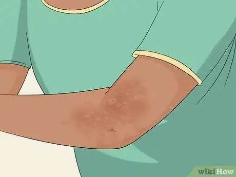 Image titled Treat Insect Bites in Toddlers Step 12