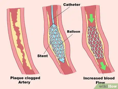 Image titled Treat Nstemi Step 13