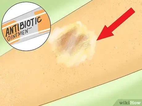 Image titled Care for Minor Abrasions and Scratches Step 4