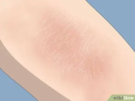 Image titled Treat Ichthyosis Step 7