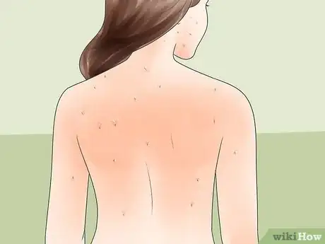 Image titled Diagnose Measles Step 4