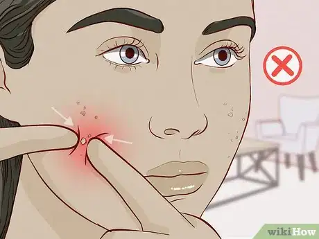 Image titled Reduce Acne Pain Step 7