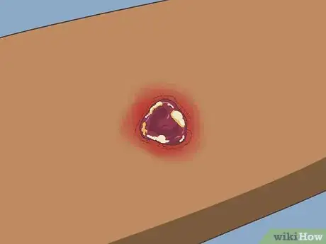 Image titled Know if a Wound Is Healing Step 2