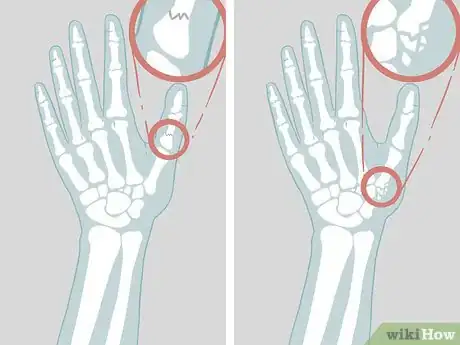 Image titled Diagnose a Broken Thumb Step 10