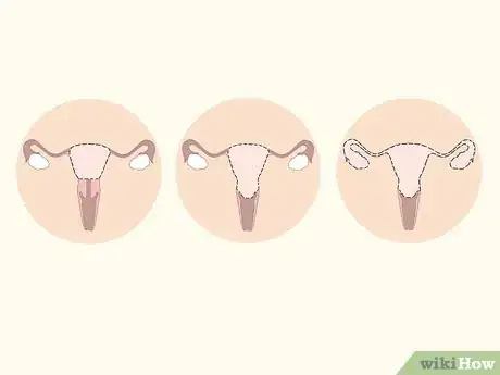 Image titled Treat Menorrhagia Step 11