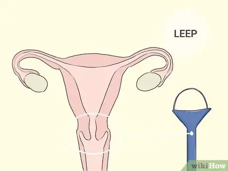 Image titled Heal Cervical Dysplasia Naturally Step 9