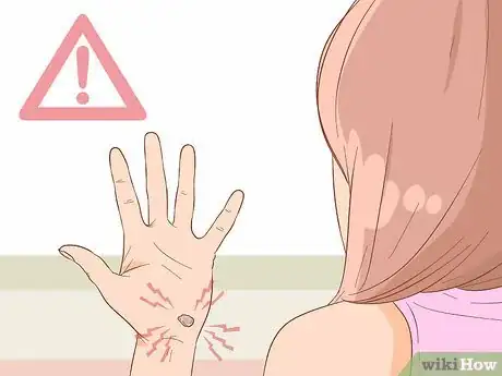 Image titled Treat a Blood Blister Step 17