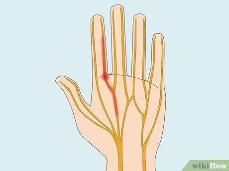 Image titled Treat Cancer with Cannabis Step 3