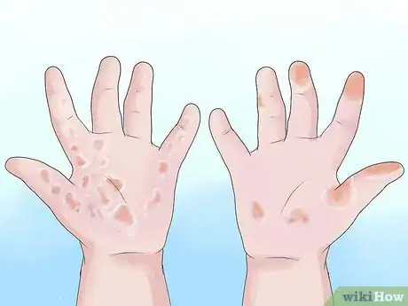 Image titled Know if Your Child Has Scarlet Fever Step 10