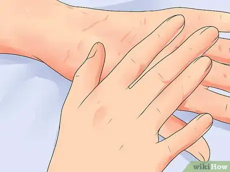 Image titled Use Boswellia Step 6