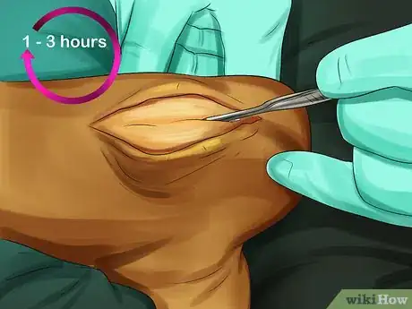 Image titled Treat Bone Spurs Step 13