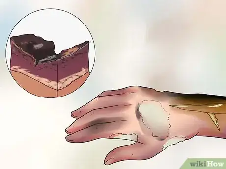 Image titled Treat a Hot Water Spill on Your Skin Step 4