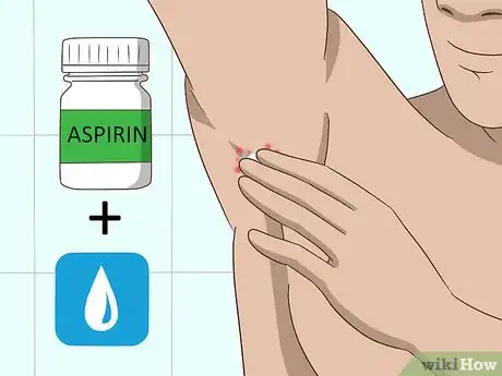 Image titled Treat Chigger Bites Step 8