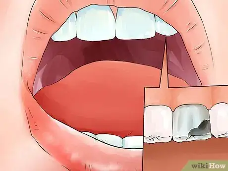 Image titled Identify if You Have Sensitive Teeth Step 7