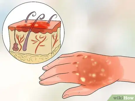 Image titled Treat a Hot Water Spill on Your Skin Step 2