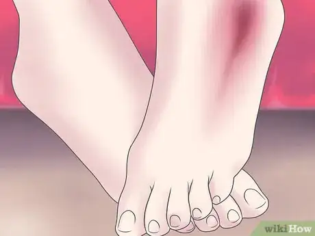 Image titled Treat a Broken Ankle Step 4