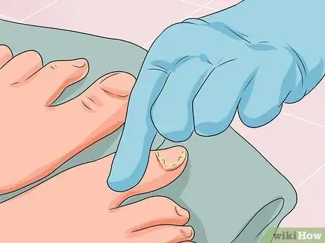 Image titled Cure Nail Fungus Step 4