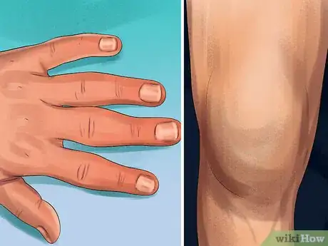 Image titled Treat Bone Spurs Step 18