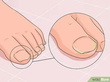 Image titled Cure Nail Fungus Step 1