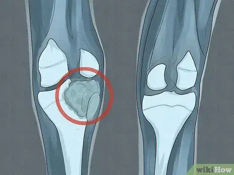 Image titled Treat Macrocytic Anemia Step 7